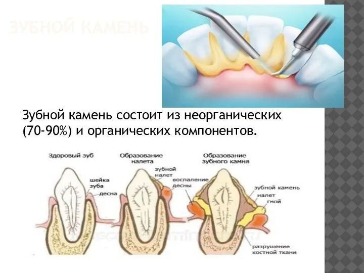 ЗУБНОЙ КАМЕНЬ Зубной камень состоит из неорганических (70-90%) и органических компонентов.