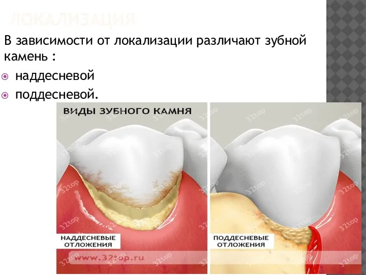 ЛОКАЛИЗАЦИЯ В зависимости от локализации различают зубной камень : наддесневой поддесневой.