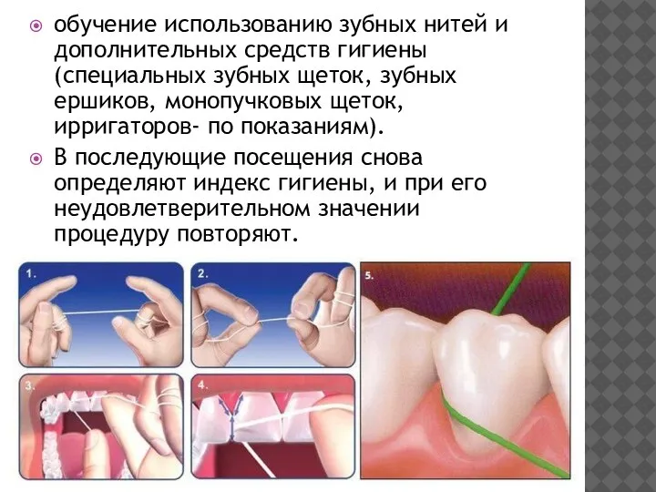обучение использованию зубных нитей и дополнительных средств гигиены (специальных зубных щеток, зубных