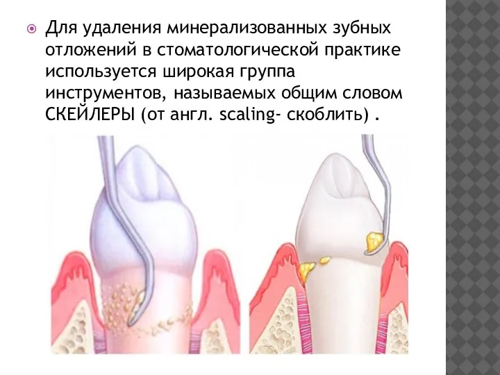 Для удаления минерализованных зубных отложений в стоматологической практике используется широкая группа инструментов,