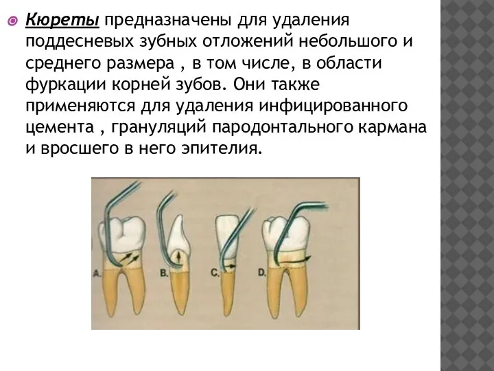 Кюреты предназначены для удаления поддесневых зубных отложений небольшого и среднего размера ,