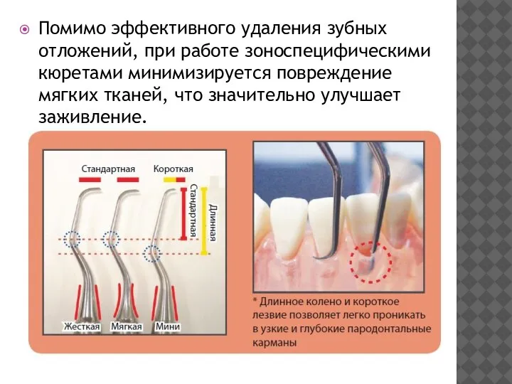 Помимо эффективного удаления зубных отложений, при работе зоноспецифическими кюретами минимизируется повреждение мягких