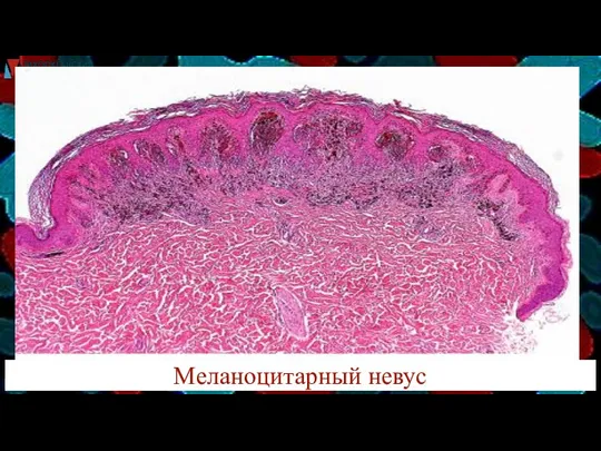 Меланоцитарный невус