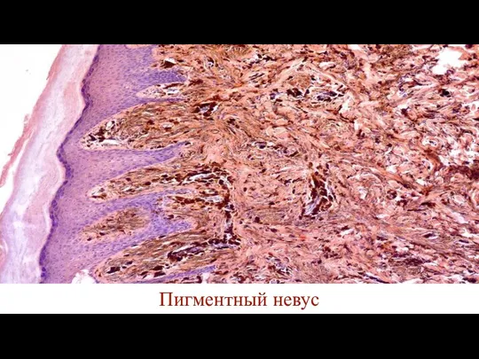 Пигментный невус