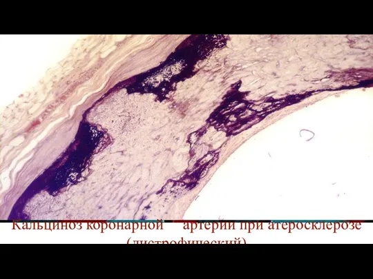 Кальциноз коронарной артерии при атеросклерозе (дистрофический)