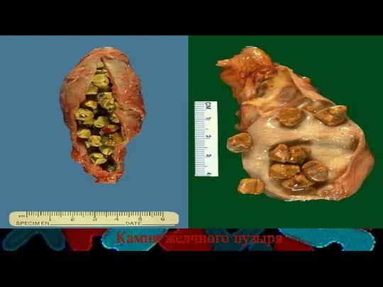 Камни желчного пузыря