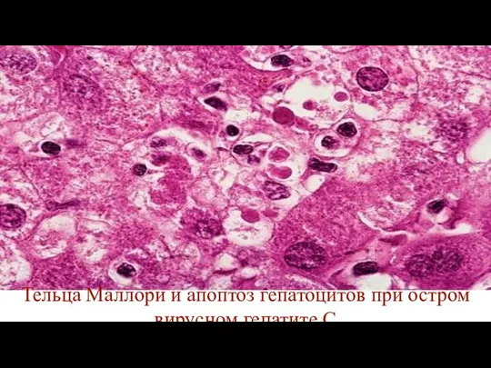 Тельца Маллори и апоптоз гепатоцитов при остром вирусном гепатите С