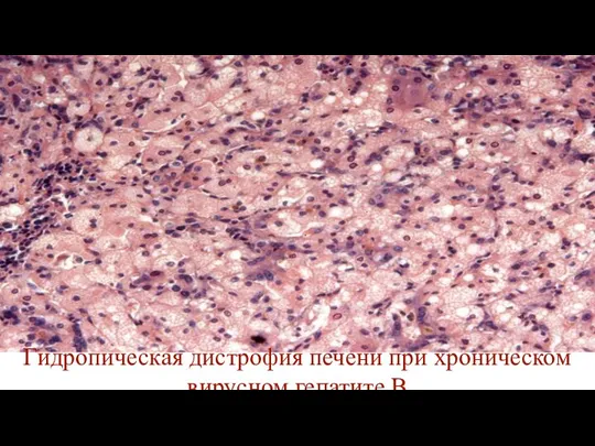 Гидропическая дистрофия печени при хроническом вирусном гепатите В