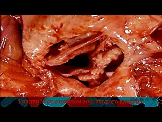Гиалиноз со стенозом аортального клапана