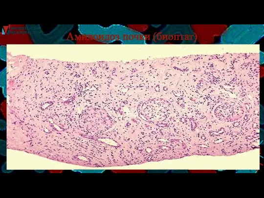 Амилоидоз почки (биоптат)