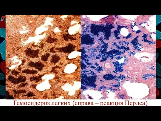 Гемосидероз легких (справа – реакция Перлса)