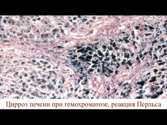 Цирроз печени при гемохроматозе, реакция Перльса