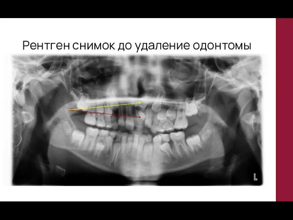 Рентген снимок до удаление одонтомы