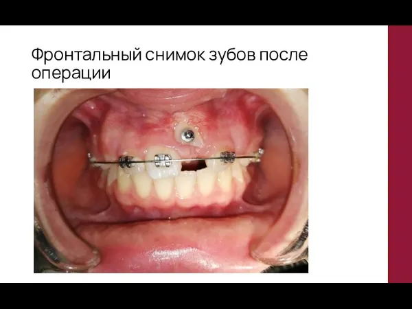 Фронтальный снимок зубов после операции