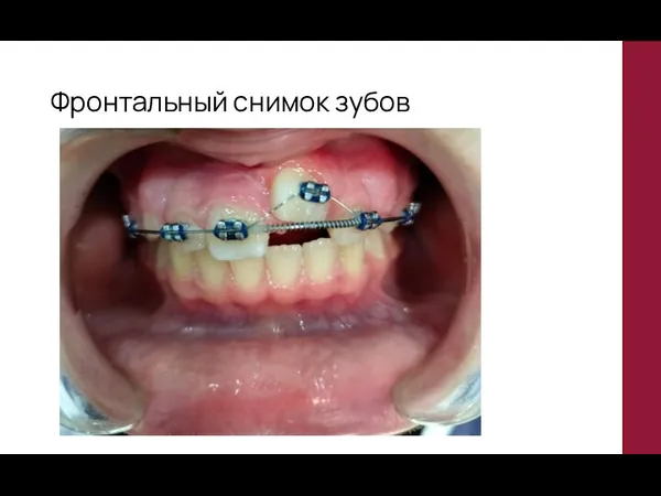 Фронтальный снимок зубов
