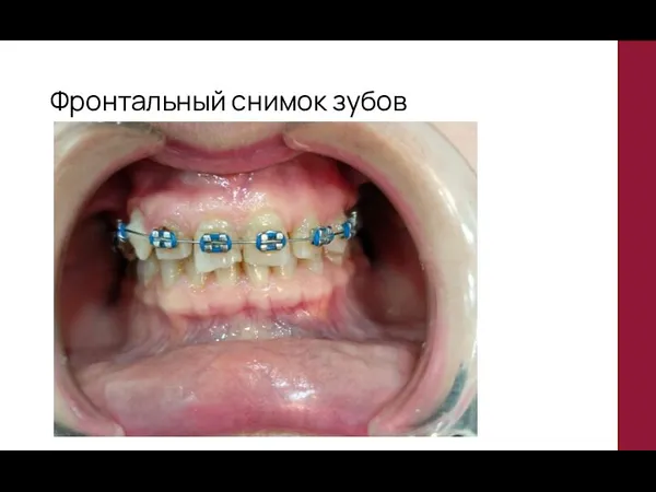 Фронтальный снимок зубов