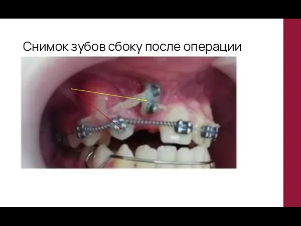Снимок зубов сбоку после операции