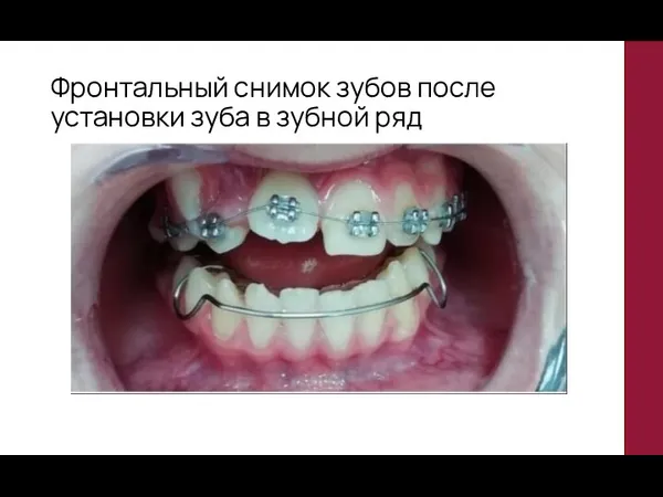 Фронтальный снимок зубов после установки зуба в зубной ряд