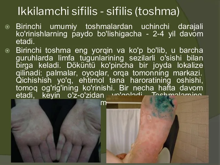 Ikkilamchi sifilis - sifilis (toshma) Birinchi umumiy toshmalardan uchinchi darajali ko'rinishlarning paydo