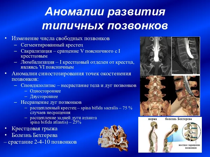 Аномалии развития типичных позвонков Изменение числа свободных позвонков Сегментированный крестец Сакрализация –