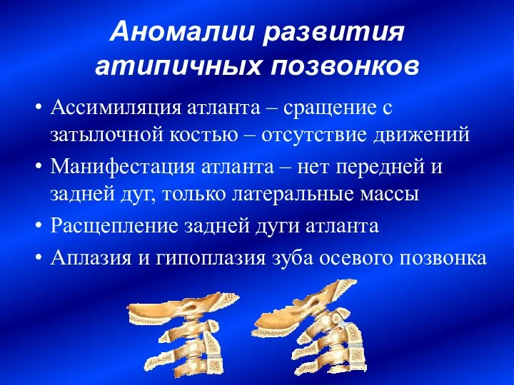 Аномалии развития атипичных позвонков Ассимиляция атланта – сращение с затылочной костью –