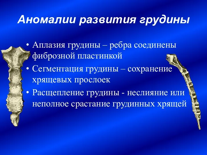 Аномалии развития грудины Аплазия грудины – ребра соединены фиброзной пластинкой Сегментация грудины