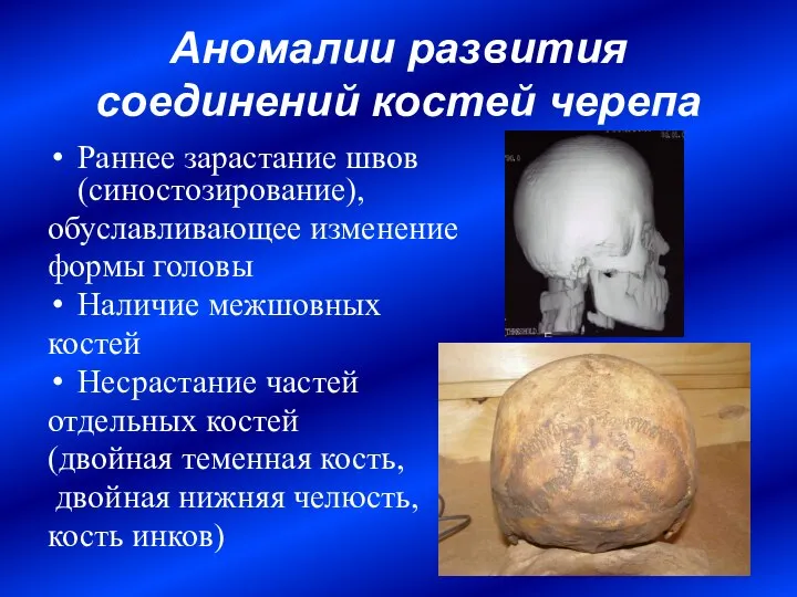 Аномалии развития соединений костей черепа Раннее зарастание швов (синостозирование), обуславливающее изменение формы