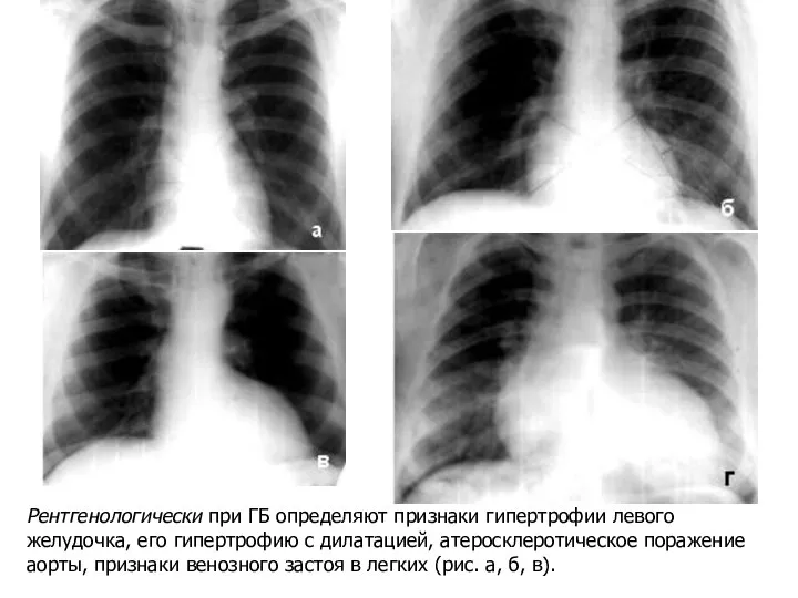 Рентгенологически при ГБ определяют признаки гипертрофии левого желудочка, его гипертрофию с дилатацией,