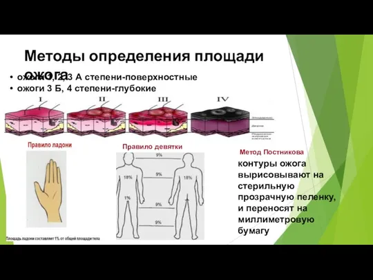 Методы определения площади ожога ожоги 1, 2, 3 А степени-поверхностные ожоги 3