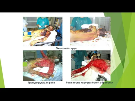 Ожоговый струп Гранулирующая рана Рана после хирургической обработки