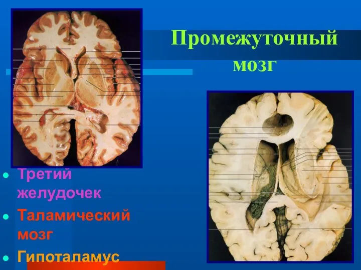 Промежуточный мозг Третий желудочек Таламический мозг Гипоталамус