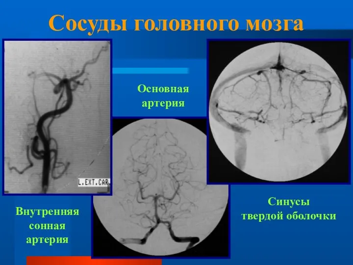 Сосуды головного мозга Внутренняя сонная артерия Основная артерия Синусы твердой оболочки