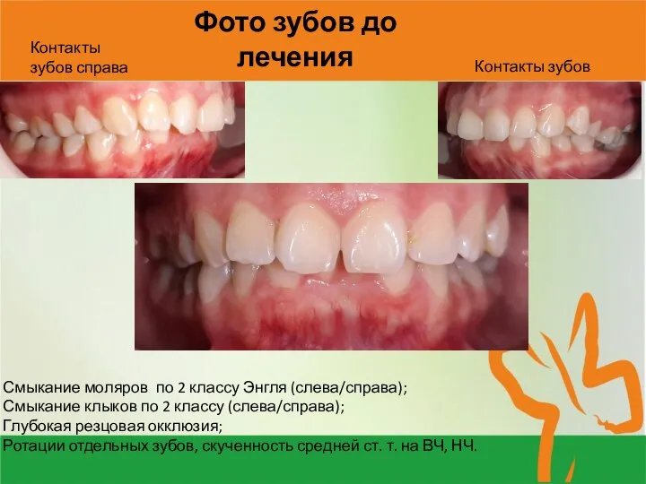 Фото зубов до лечения Смыкание моляров по 2 классу Энгля (слева/справа); Смыкание
