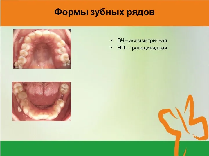 Формы зубных рядов ВЧ – асимметричная НЧ – трапецивидная