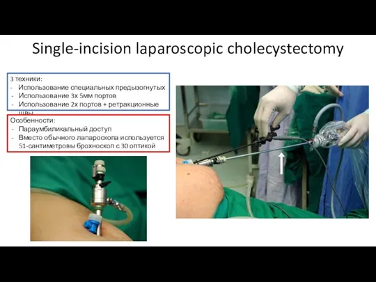 Single-incision laparoscopic cholecystectomy 3 техники: - Использование специальных предызогнутых Использование 3х 5мм