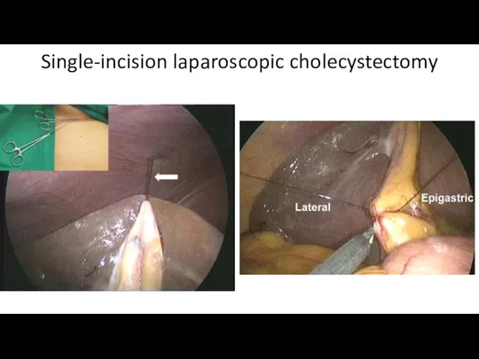 Single-incision laparoscopic cholecystectomy