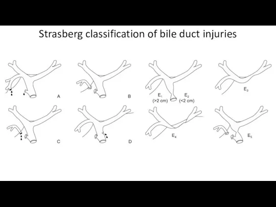 Strasberg classification of bile duct injuries