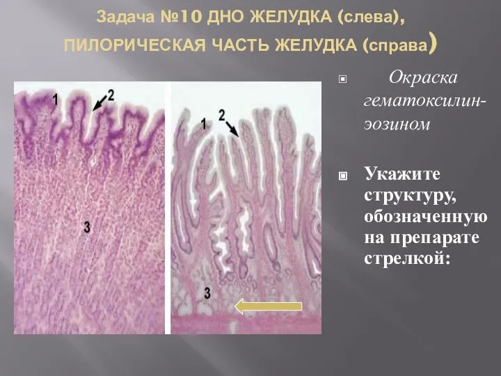 Задача №10 ДНО ЖЕЛУДКА (слева), ПИЛОРИЧЕСКАЯ ЧАСТЬ ЖЕЛУДКА (справа) Окраска гематоксилин-эозином Укажите