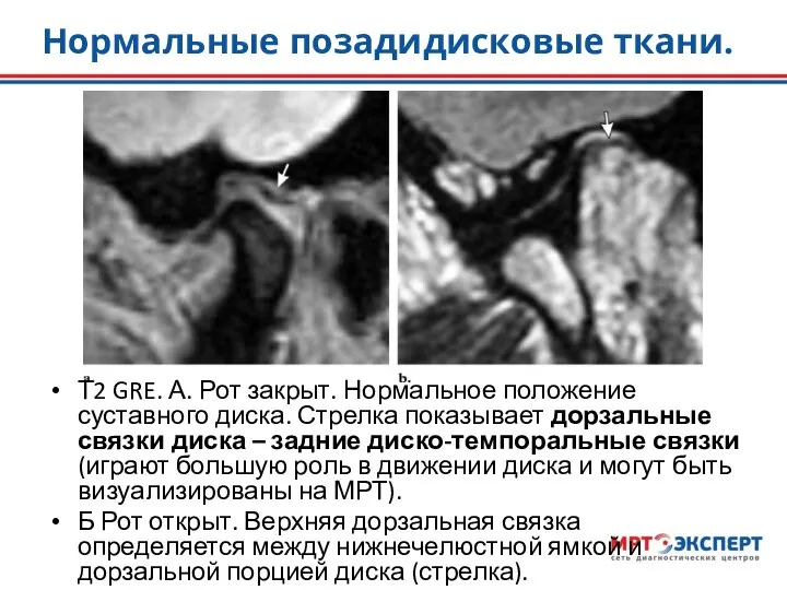Нормальные позадидисковые ткани. Т2 GRE. А. Рот закрыт. Нормальное положение суставного диска.