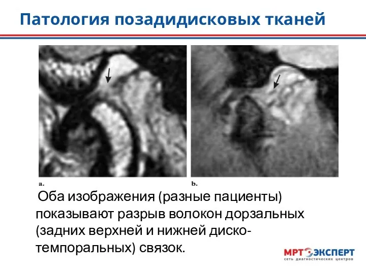 Патология позадидисковых тканей Оба изображения (разные пациенты) показывают разрыв волокон дорзальных (задних