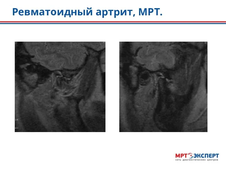 Ревматоидный артрит, МРТ.