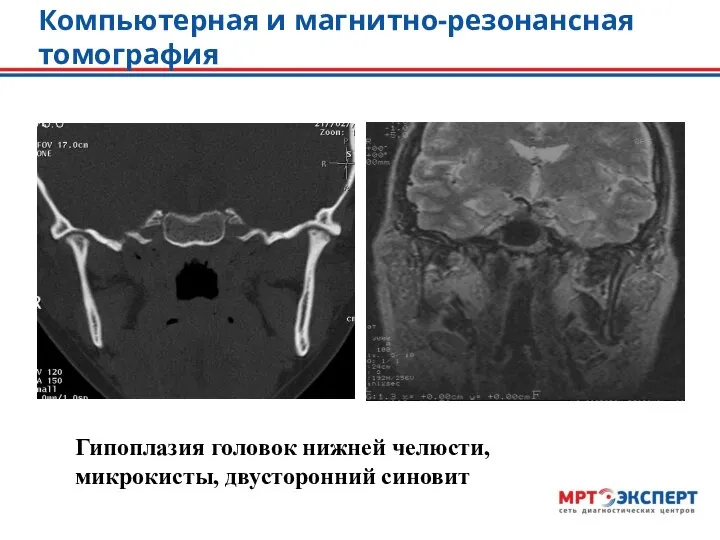 Компьютерная и магнитно-резонансная томография Гипоплазия головок нижней челюсти, микрокисты, двусторонний синовит