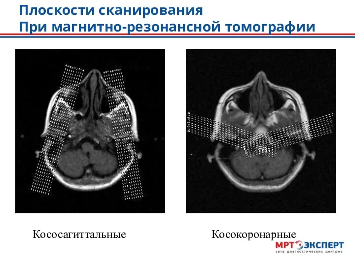 Плоскости сканирования При магнитно-резонансной томографии Кососагиттальные Косокоронарные