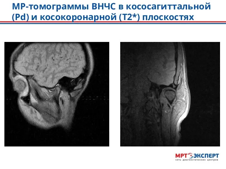 МР-томограммы ВНЧС в кососагиттальной (Pd) и косокоронарной (Т2*) плоскостях