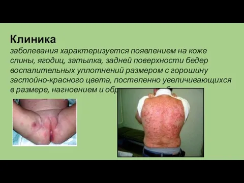 Клиника заболевания характеризуется появлением на коже спины, ягодиц, затылка, задней поверхности бедер