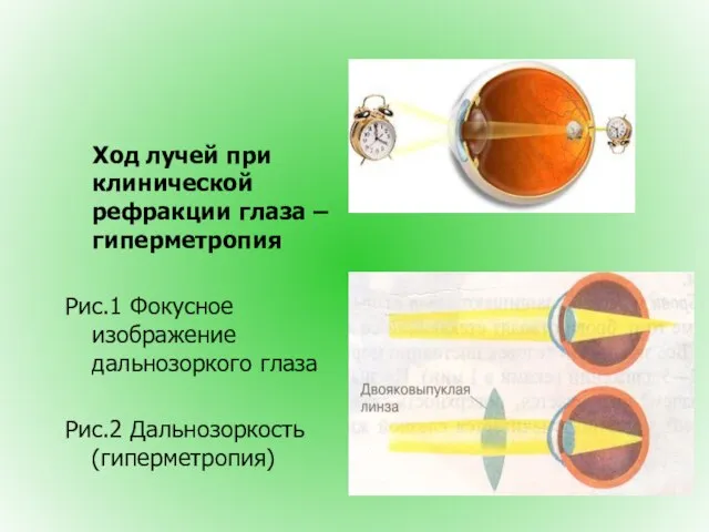 Ход лучей при клинической рефракции глаза – гиперметропия Рис.1 Фокусное изображение дальнозоркого глаза Рис.2 Дальнозоркость (гиперметропия)
