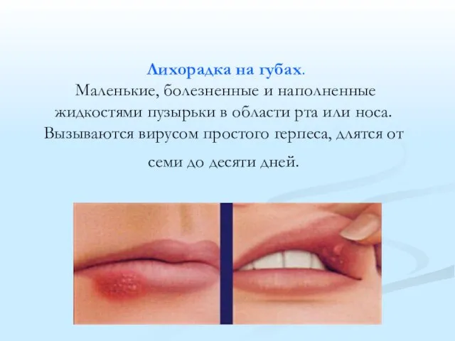 Лихорадка на губах. Маленькие, болезненные и наполненные жидкостями пузырьки в области рта