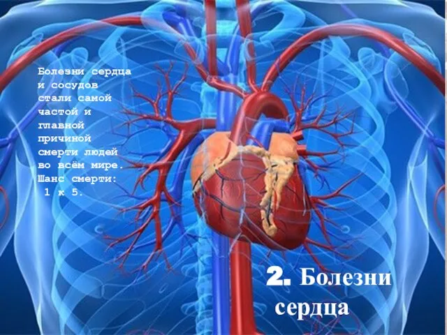 2. Болезни сердца Болезни сердца и сосудов стали самой частой и главной