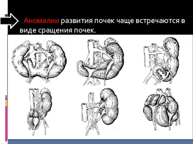 Аномалии развития почек чаще встречаются в виде сращения почек.