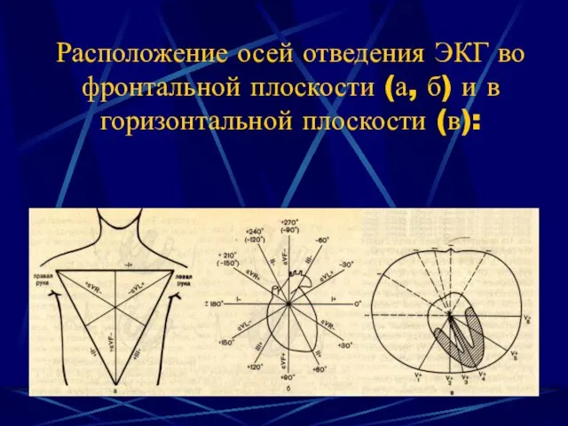 Расположение осей отведения ЭКГ во фронтальной плоскости (а, б) и в горизонтальной плоскости (в):